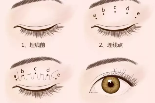 <a href='/zz/' target='_blank'><u>鄭州美萊</u></a>整形埋線雙眼皮做的怎么樣?