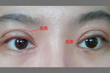 雙眼皮失敗了怎么辦？<a href='/zz/' target='_blank'><u>鄭州美萊</u></a>醫(yī)院助你重獲新生