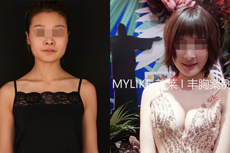 <a href='/zz/' target='_blank'><u>鄭州美萊</u></a>整形假體豐胸和自體豐胸哪個(gè)好？