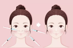 鄭州美萊整形打完瘦臉針有副作用嗎？