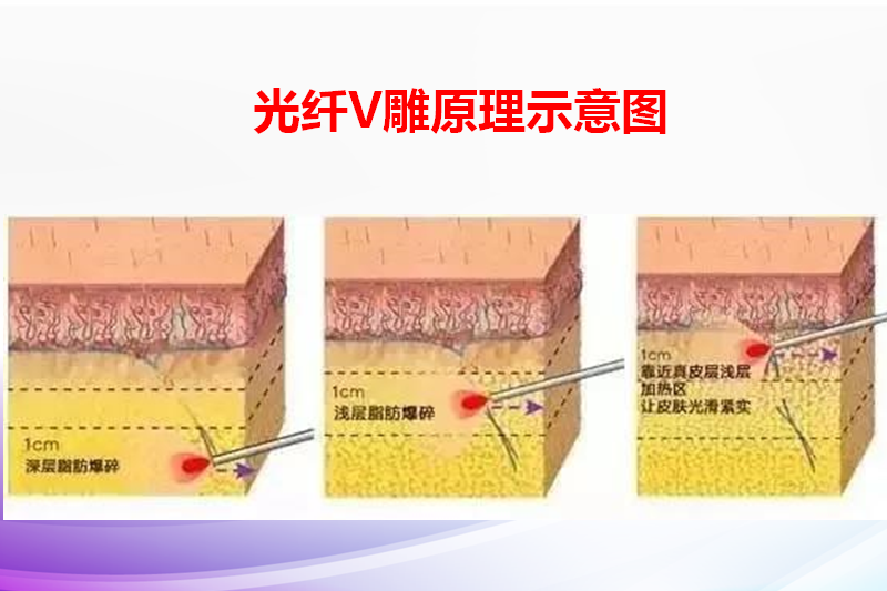 <a href='/zz/' target='_blank'><u>鄭州美萊</u></a> 光纖V雕 抗衰祛疤新方法