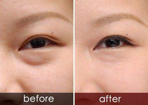 深圳美萊祛除眼袋的好辦法是什么?