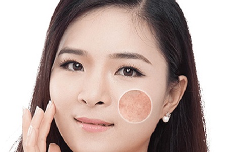 臉上長(zhǎng)斑不要慌 這樣做讓你重回自信