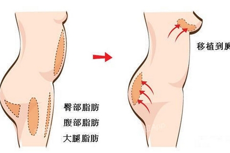 曲靖自體脂肪豐胸維持多久?有哪些優(yōu)點(diǎn)