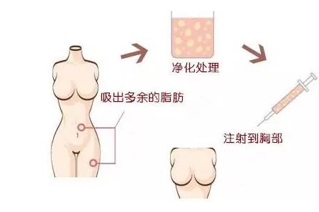 曲靖自體脂肪豐胸維持多久?有哪些優(yōu)點(diǎn)