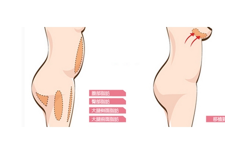 曲靖自體脂肪豐胸維持多久?有哪些優(yōu)點(diǎn)