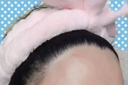 常州發(fā)際線調(diào)整效果好嗎,發(fā)際線如何調(diào)整?