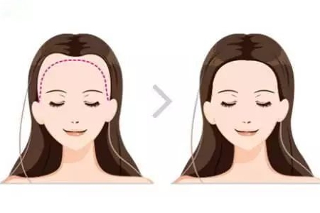 常州發(fā)際線調(diào)整效果好嗎,發(fā)際線如何調(diào)整?