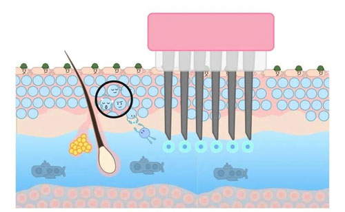 想要嫩膚,應該選擇做光電還是水光