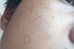 激光除疤4cm一般多少錢，需要做幾次治療