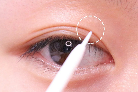 廣州做雙眼皮整形手術要多少錢,會不會很貴