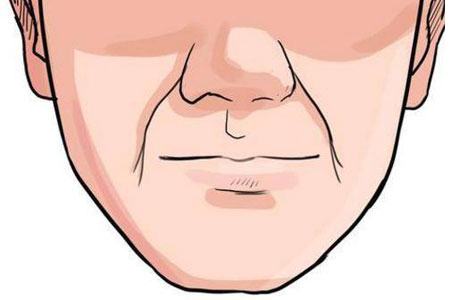 注射玻尿酸去除法令紋多少錢(qián)