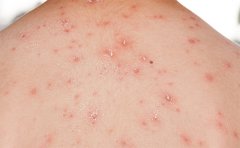 去醫(yī)院祛痘印大概多少錢，重慶、鄭州、武漢價(jià)格參考