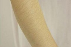 冰點手臂脫毛效果好不好，術后需要注意什么